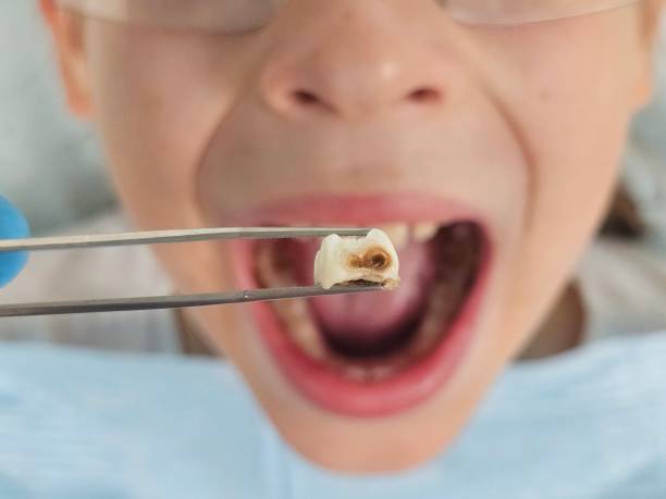 Best Broken Tooth Emergency  in Belmont, VA